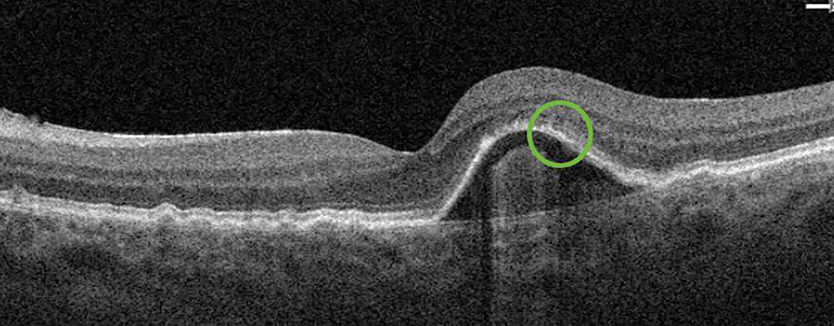 Fig. 4. The subretinal fluid (previously in the green circle) observed during the first post-alert examination resolved after the initiation of anti-VEGF therapy.