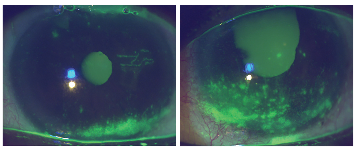 Right and left anterior segment photographs demonstrating corneal epithelial staining, reduced tear meniscus and conjunctival injection.