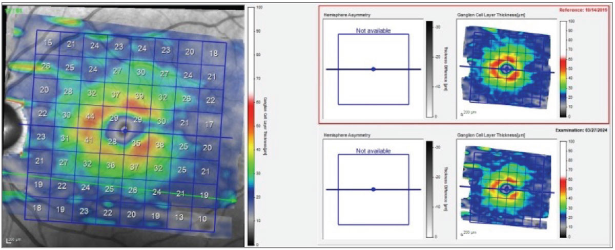 Fig. 3. The change in retinal ganglion cell thickness from baseline to most recent scan. Note loss of retinal GCL thickness over this time period.