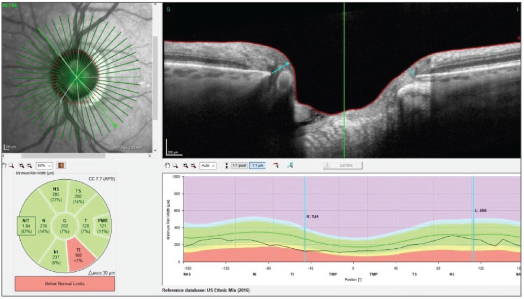 Fig. 4. The baseline neuro OCT of the left eye shows a rather normal BMO-MRW, except for the inferotemporal sector, which is consistent with the glaucomatous defect seen at the initial visit.