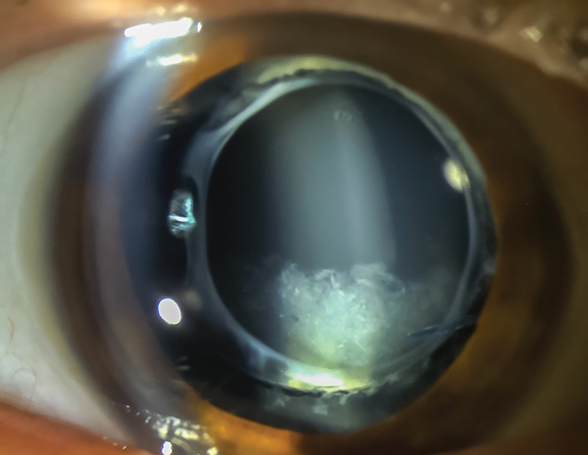 Fig. 2. Opaque, turbid fluid between the IOL and the posterior capsule is present in late capsular bag distention syndrome.