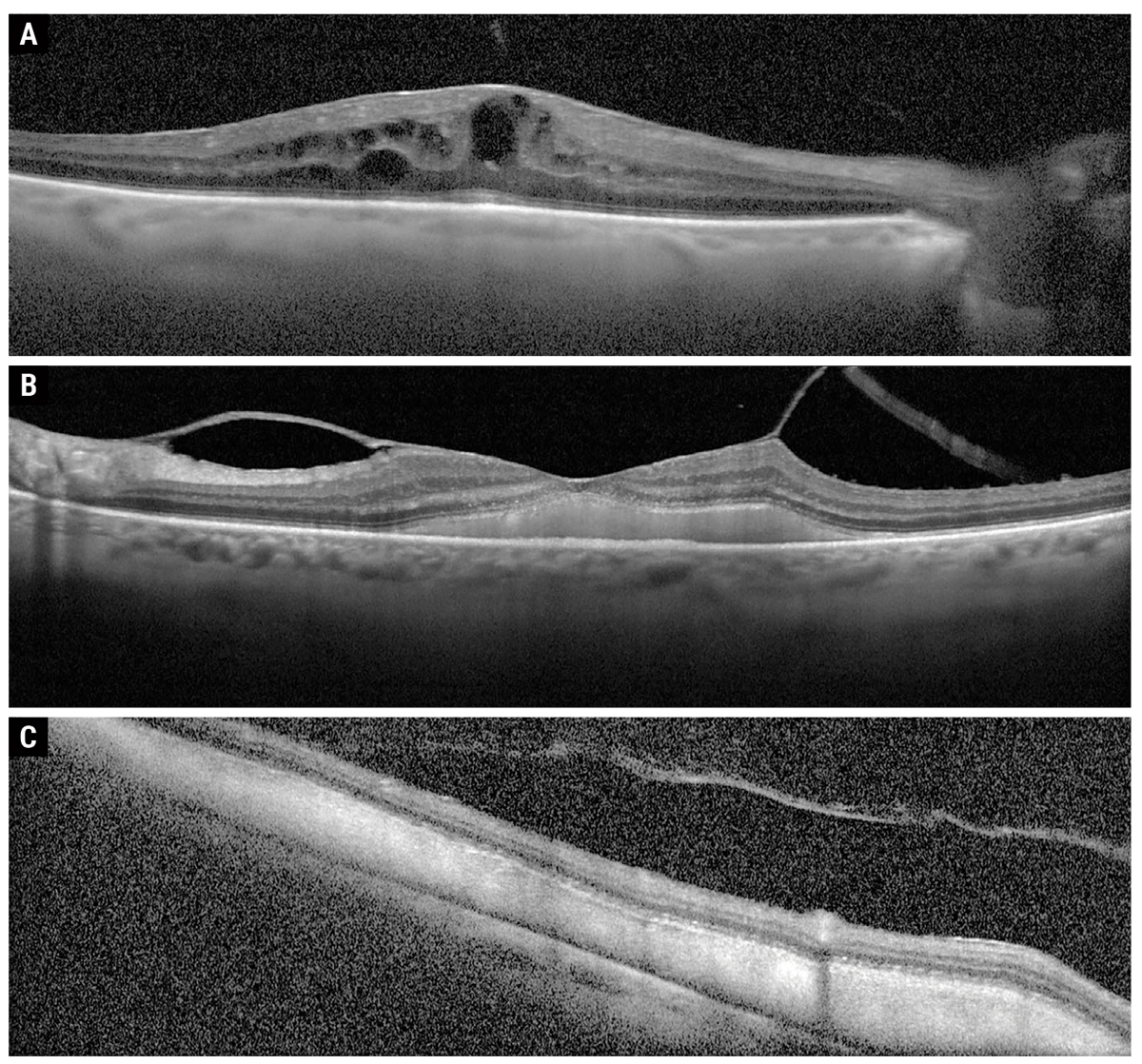 Fig. 2. Macular OCT of OD (A) and OS (B), as well as eccentric OCT over inferior macula OS (C).