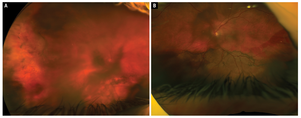 Fig. 3. One-month follow-up Optos fundus photos of the right eye (A) and left eye (B).