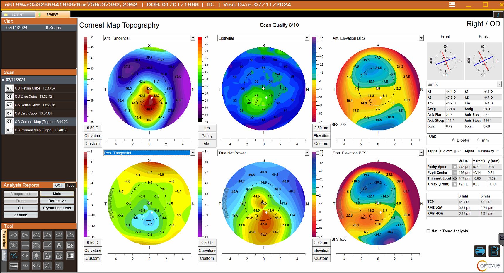 Owners of the Optovue Solix FullRange or Solix Essential OCT/OCT-A system can add the corneal topography module to their existing device.