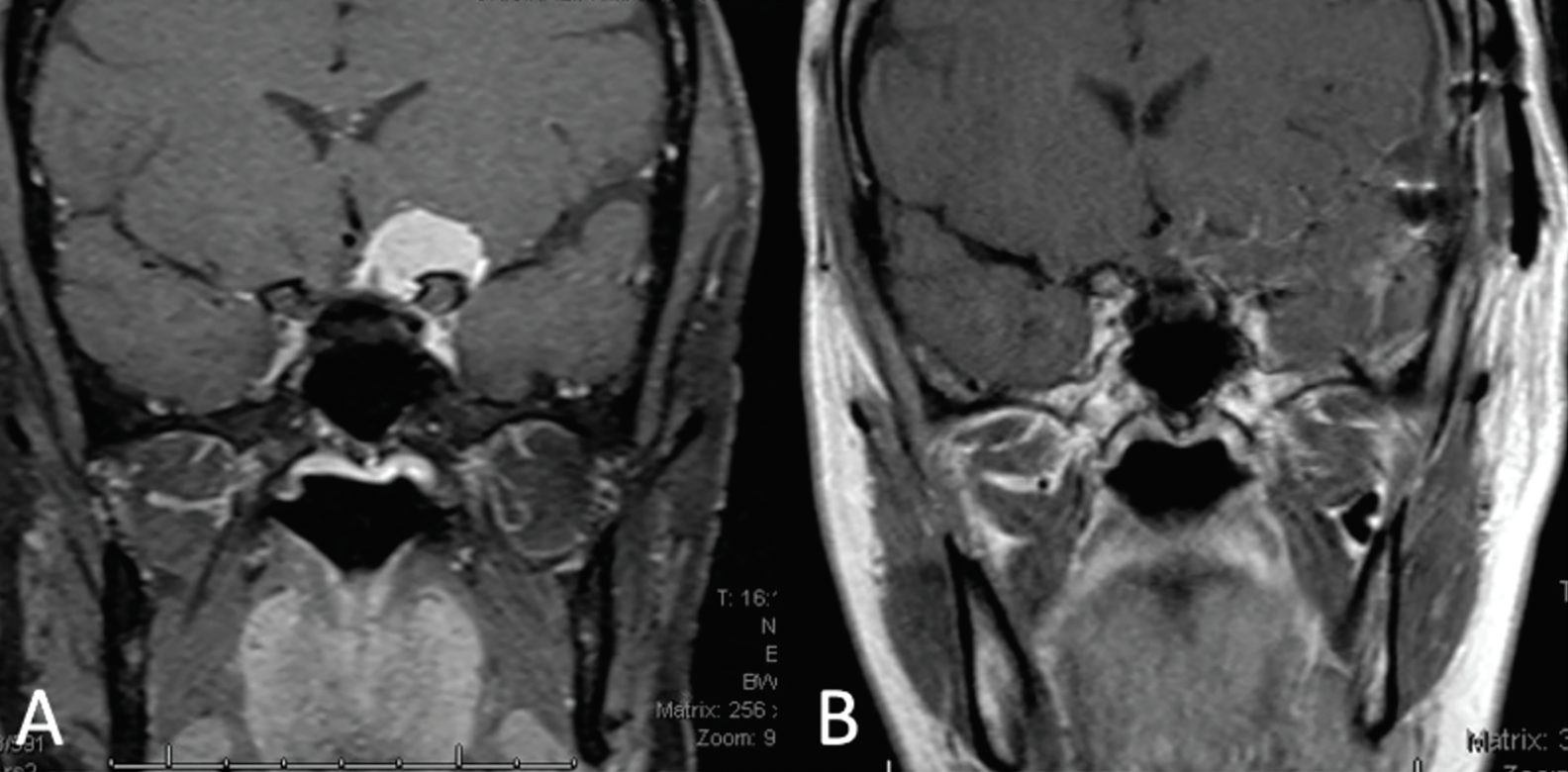 Fig 2. (A) Coronal MRI depicts an approximately 2cm paraclinoid meningioma exerting its mass effect on the left half of the optic chiasm and the prechiasmic optic nerve. (B) Coronal MRI taken two weeks post-craniotomy and resection of the meningioma. 