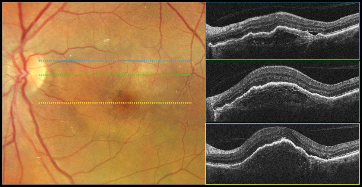 Only one of eight ocular disorders analyzed in this study—wet AMD—was found to be associated with vitamin D levels.