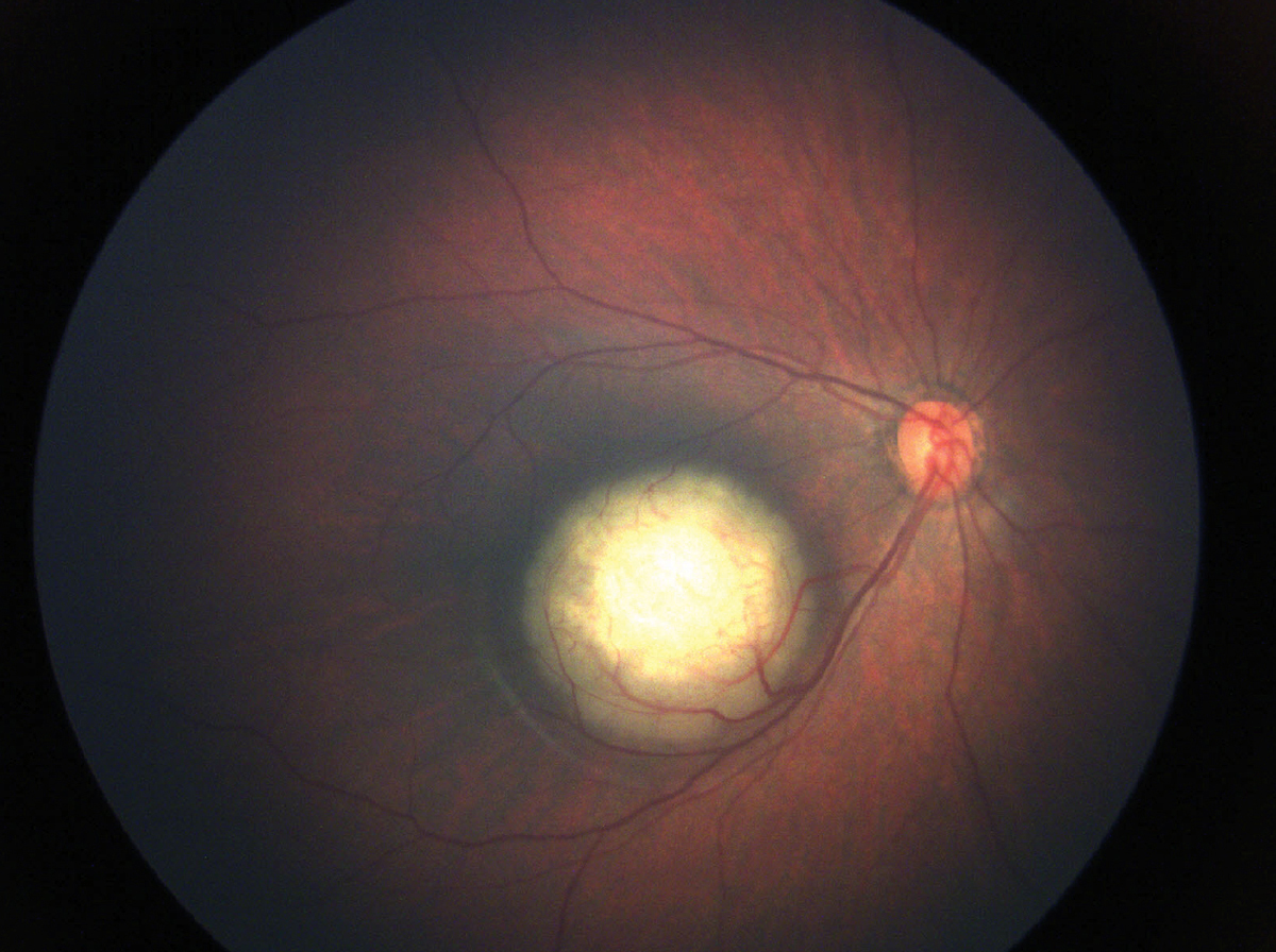 Children with retinoblastoma who received adjuvant chemotherapy after enucleation showed improved survival and reduced tumor recurrence, highlighting the importance of standardized treatment protocols.