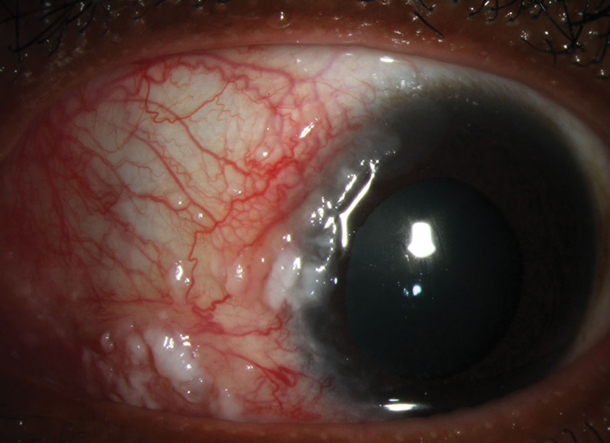 Of patients with a higher histopathological grade in the resected OSSN lesion, LSCD prevalence was higher; this reflects the fact that higher grade OSSN lesions can grow larger and behave more aggressively, thus helping to explain why prevalence is higher in these patients. 