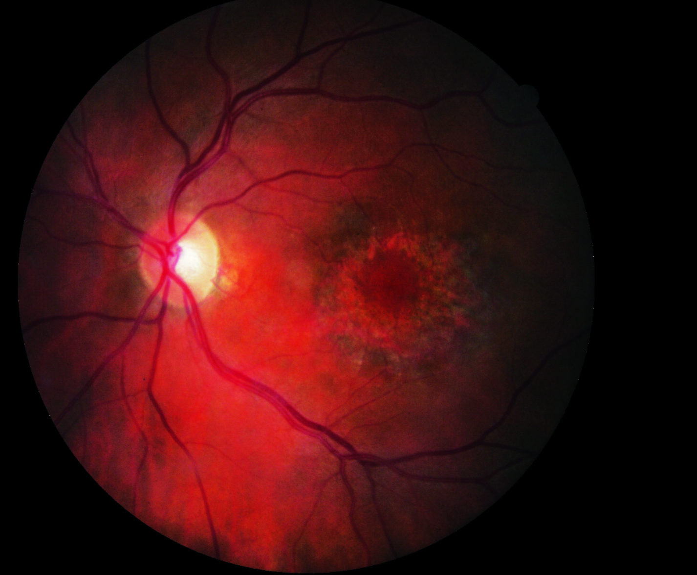 This recent study identified a novel aspect regarding the association between initial and most recent OCTs with ONL damage in patients who take hydroxychloroquine, revealing thinning in the foveal zone.