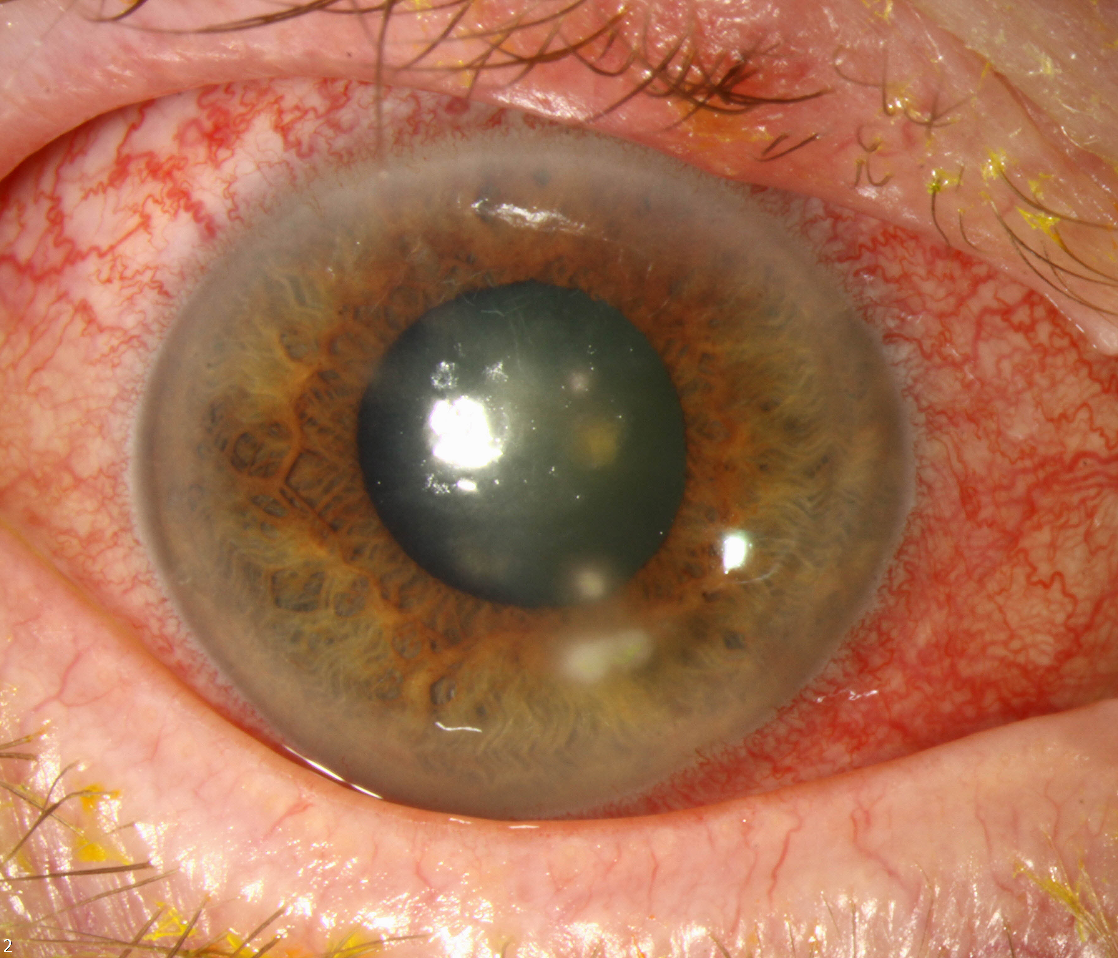 Those who received topical corticosteroids at initial presentation were four times more likely to develop ocular complications, with over 70% of patients who received steroids having initial presentation of endothelial keratitis or uveitis. 