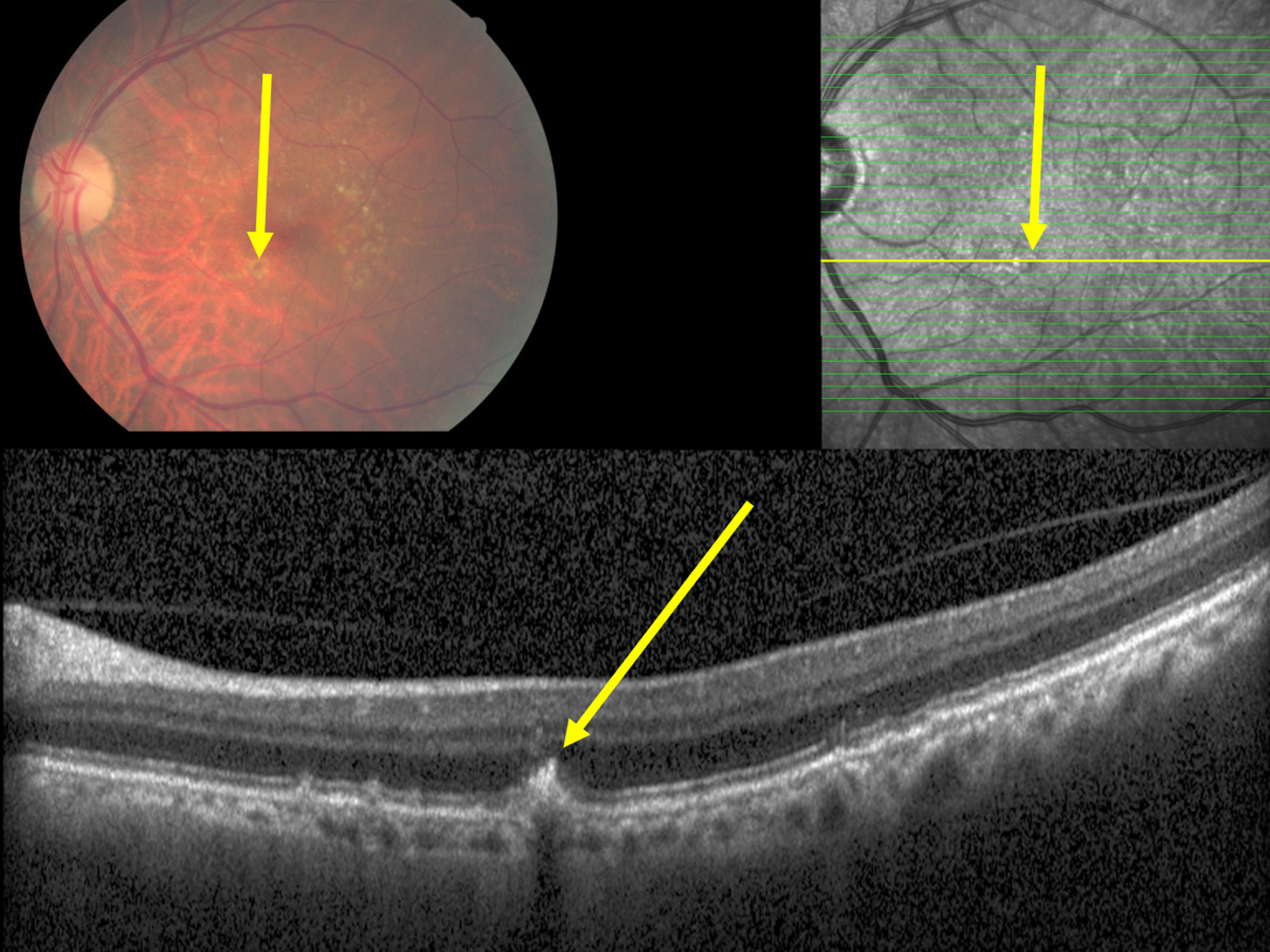 A correlation between intraretinal hyperreflective bodies and spatially correlated defects in the ellipsoid zone and ELM also corresponded to the finding obtained in the histologic part of the same study, in which intraretinally located RPE cells were spatially correlated with defects in the ELM. This image from the study shows macular hyperpigmentation (yellow arrow) corresponding to a plume-like intraretinal hyperreflective body in the outer nuclear layer (yellow arrow), apparently emerging out of the RPE line, with a corresponding localized defect in the inner segment/outer segment line and defect in the outer external limiting membrane.