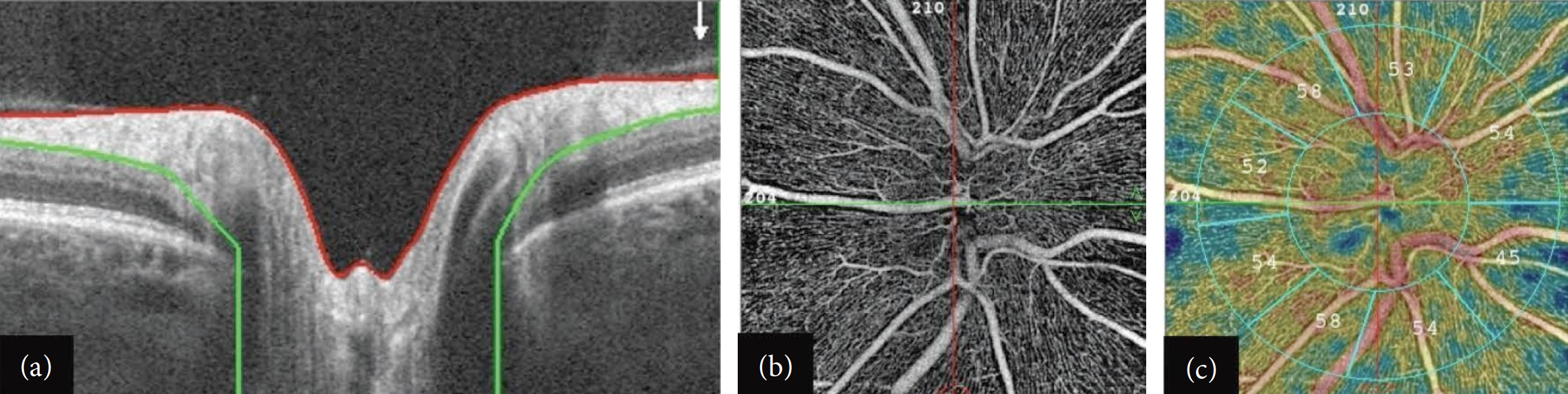 Clinicians should not rely solely on RNFL thickness when assessing optic disc swelling, researchers warn. Rather, vessel density on OCT-A may be a critical parameter in distinguishing between pseudo-optic disc swelling and true edema conditions. This image from the study shows: (a) RNFL segmentation from the ILM (red line) to the posterior boundary (green line); (b) OCT-A scan centered on the optic disc at the level of the radial peripapillary capillary (RPC) slab in a healthy subject; (c) corresponding RPC density measurements in different sectors. After removing large vessel signals, automatic calculations of RPC density are performed in the areas of peripapillary (between the two concentric blue circles) and the whole image in different sectors, expressed in percentages.