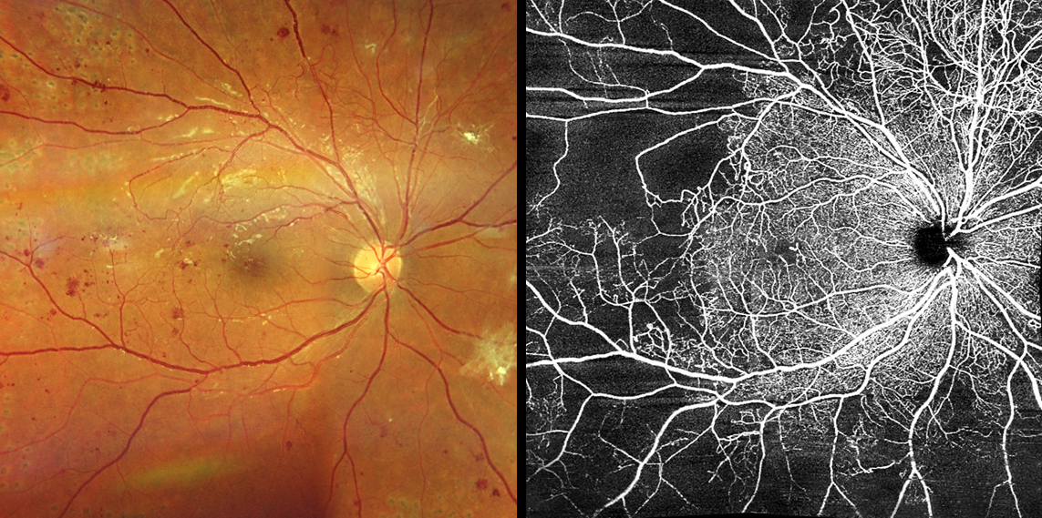 Previous investigations have found disruptions to circadian rhythm like shift work and social jetlag are associated with type 2 diabetes, and glucose homeostasis is essential in maintenance of normal physiological function of retinal cells. 