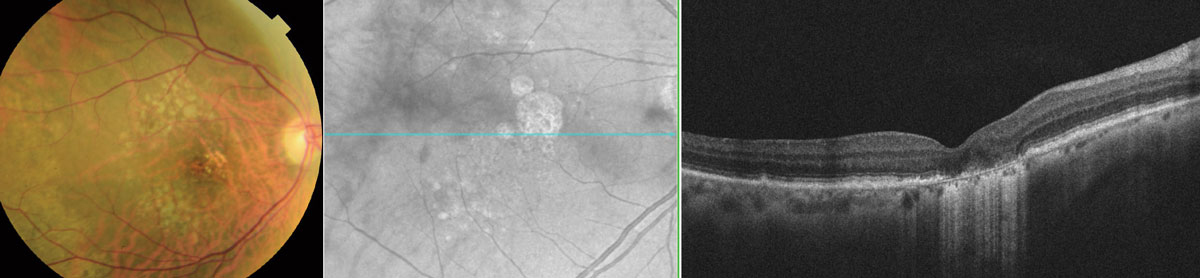 Patients with geographic atrophy in this study lost, on average, two to three lines of visual acuity over the three-year follow-up period.