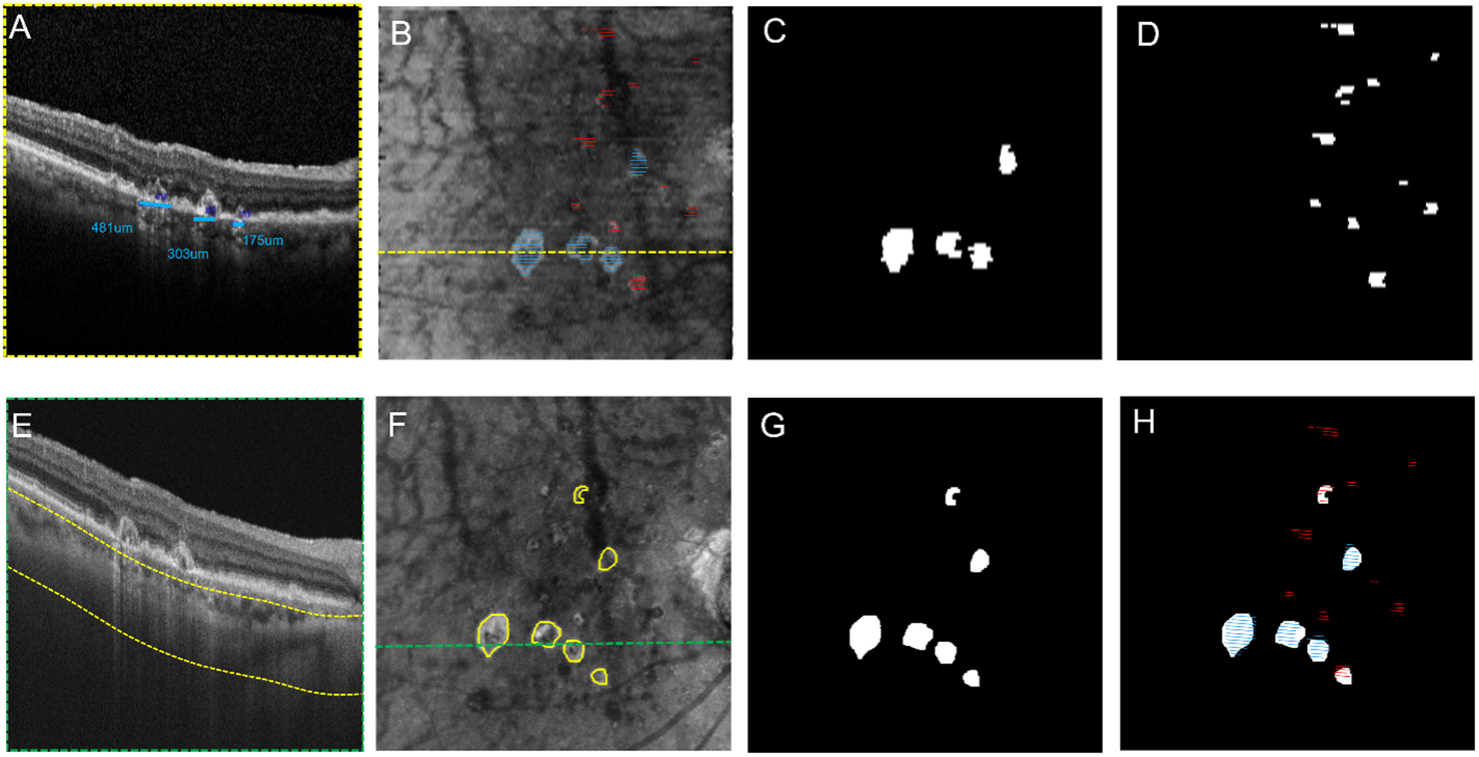 En Face OCT Better than B-Scan in Diagnosis of Early Macular Atrophy in AMD