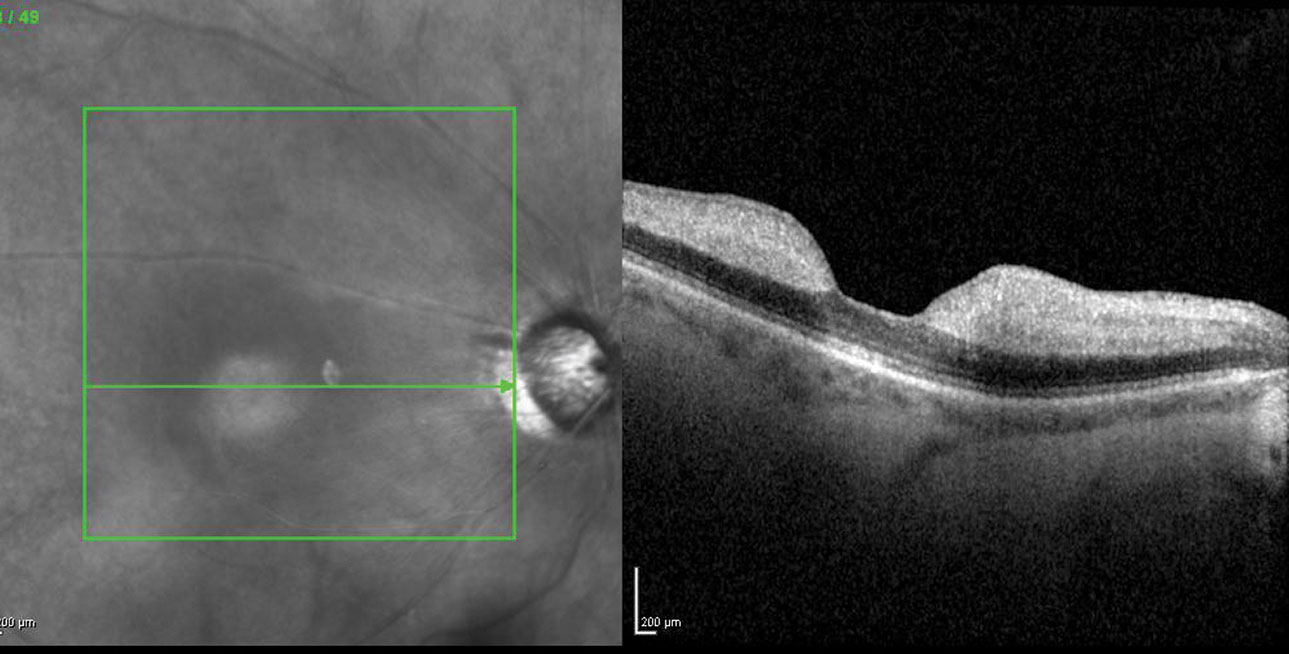 Despite visual improvements in some patients, vision better than the legal blindness definition occurred in only about 5% of cases. 