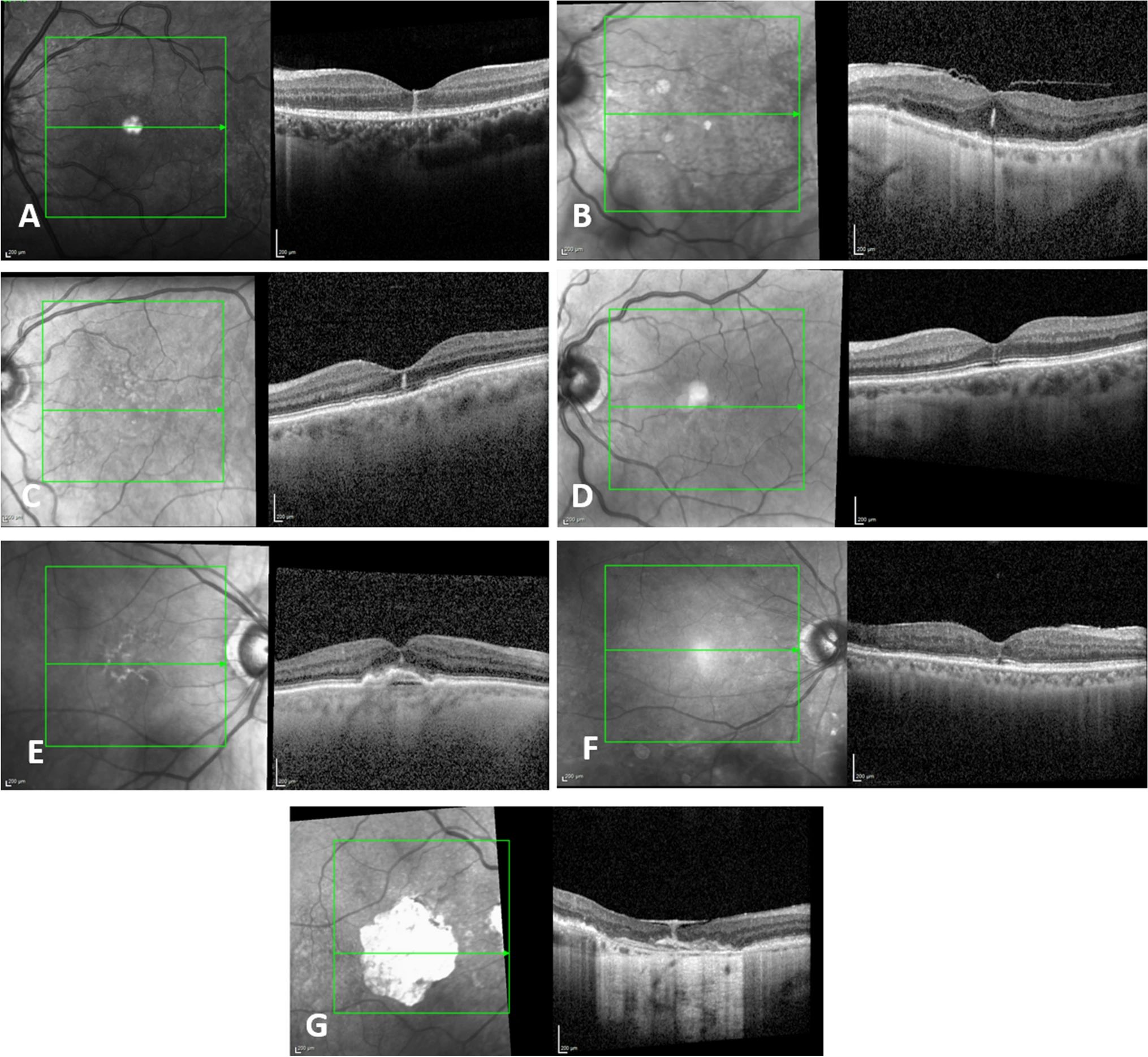 Researchers observed several different underlying disorders among patients with foveal hyperreflective vertical lines detected on SD-OCT, though no particular line pattern characterized any of the differential diagnoses. This image from the study shows Examples of FVL in different clinical settings: (A) inflammation, (B) mechanical, (C) resorption of fluids, (D) macular telangiectasia, (E) AMD, (F) diabetic retinopathy, (G) scar.