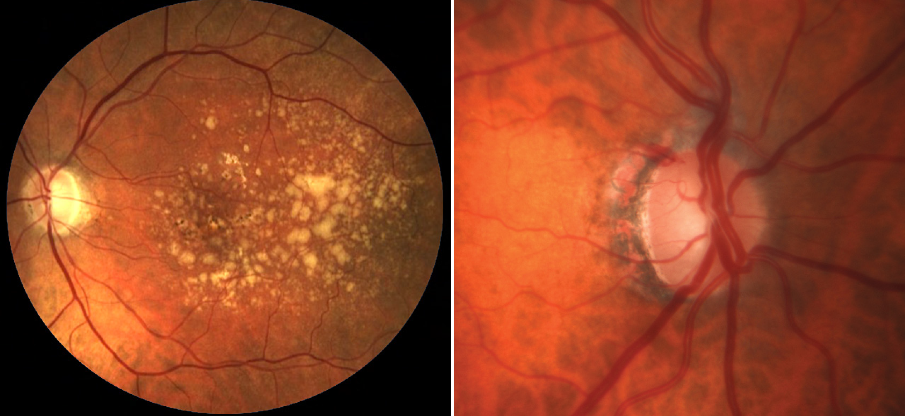 AMD and glaucoma individually indicate a high rate of systemic comorbidities, notably a higher prevalence of heart failure and dementia, than those with either disease alone.