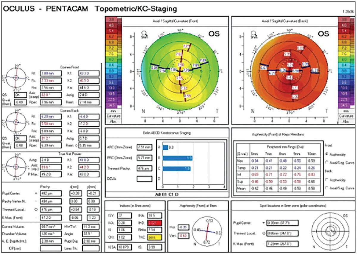 Children with clinical suspicion for keratoconus had a high rate of at least one indeterminate value on Scheimpflug imaging, and can be helpful markers in monitoring for subclinical disease over time.