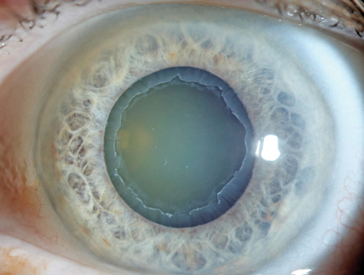 Patients with exudative AMD at the time of exfoliation syndrome diagnosis were most likely to convert to exfoliative glaucoma within three years in this population-based study. 