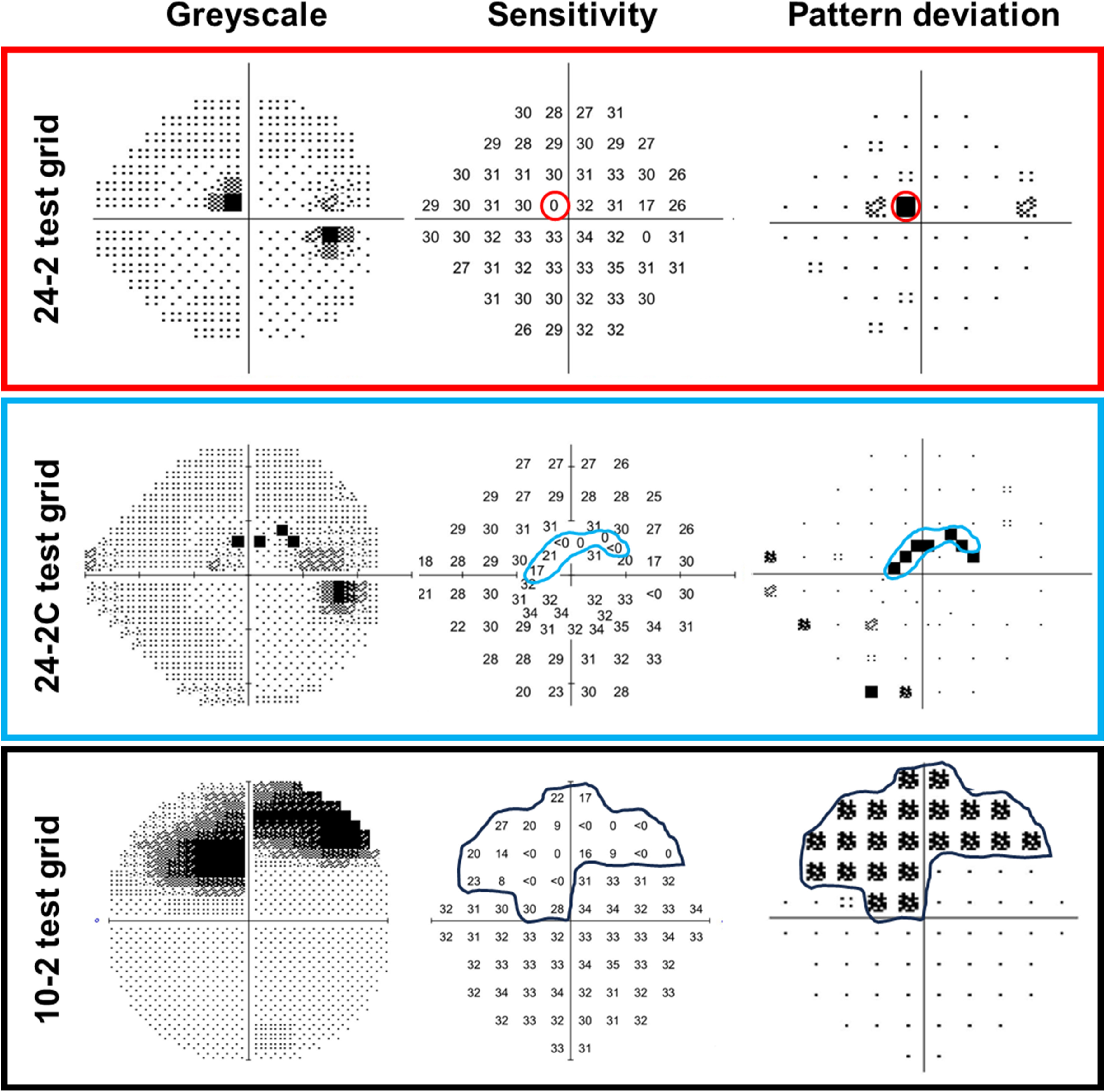 One of the many points illustrated in the paper concerns the influence of stimulus size and test grid selections. These images from the paper give examples comparing glaucomatous visual field defects across different test grids for a 34-year-old patient with low-tension glaucoma and a central visual field defect when using three static perimetry test grids: the 24-2, 24-2C and 10-2.