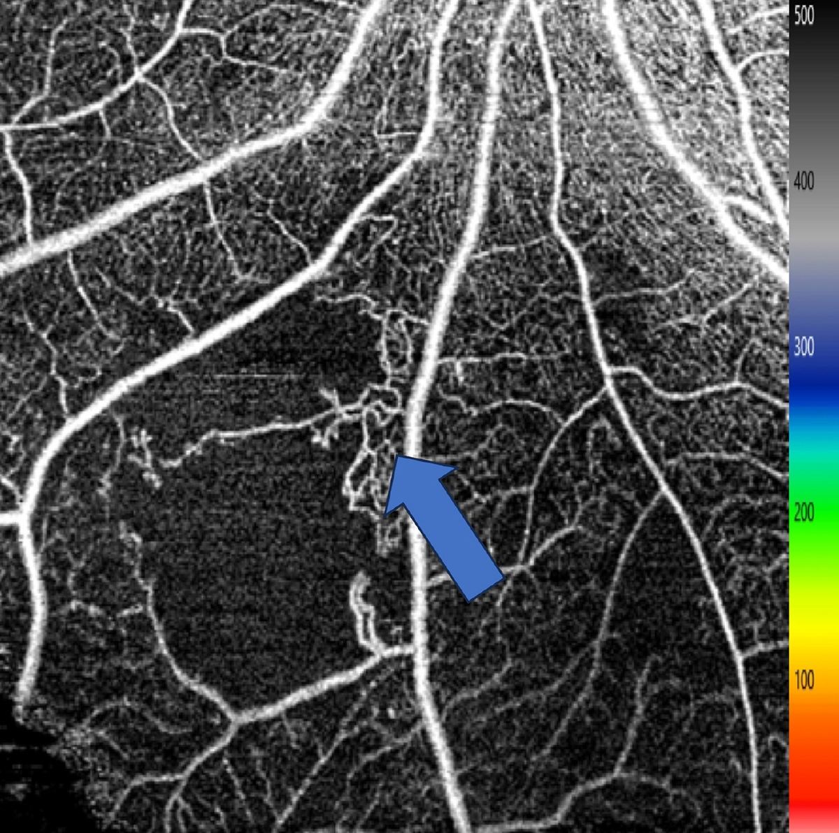 Intraretinal Microvascular Abnormalities, Ischemia Associated with High ...