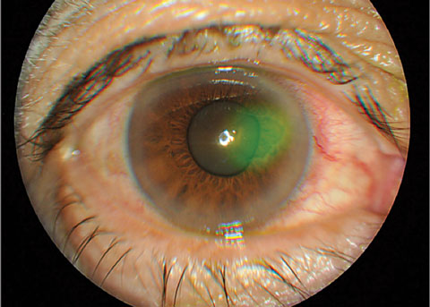 A recent study from the Cleveland Clinic and published in the journal Cornea reveals that higher doses of topical losartan, used for corneal injuries, may lead to increased ocular toxicity and discomfort. Researchers found that while traditional dosing of 0.8mg/mL is effective and safe, higher concentrations (8mg/mL and 40 mg/mL) resulted in severe side effects. They also suggested an even lower dose of the medication—0.2mg/mL six times a day—for corneas with epithelial defects. 