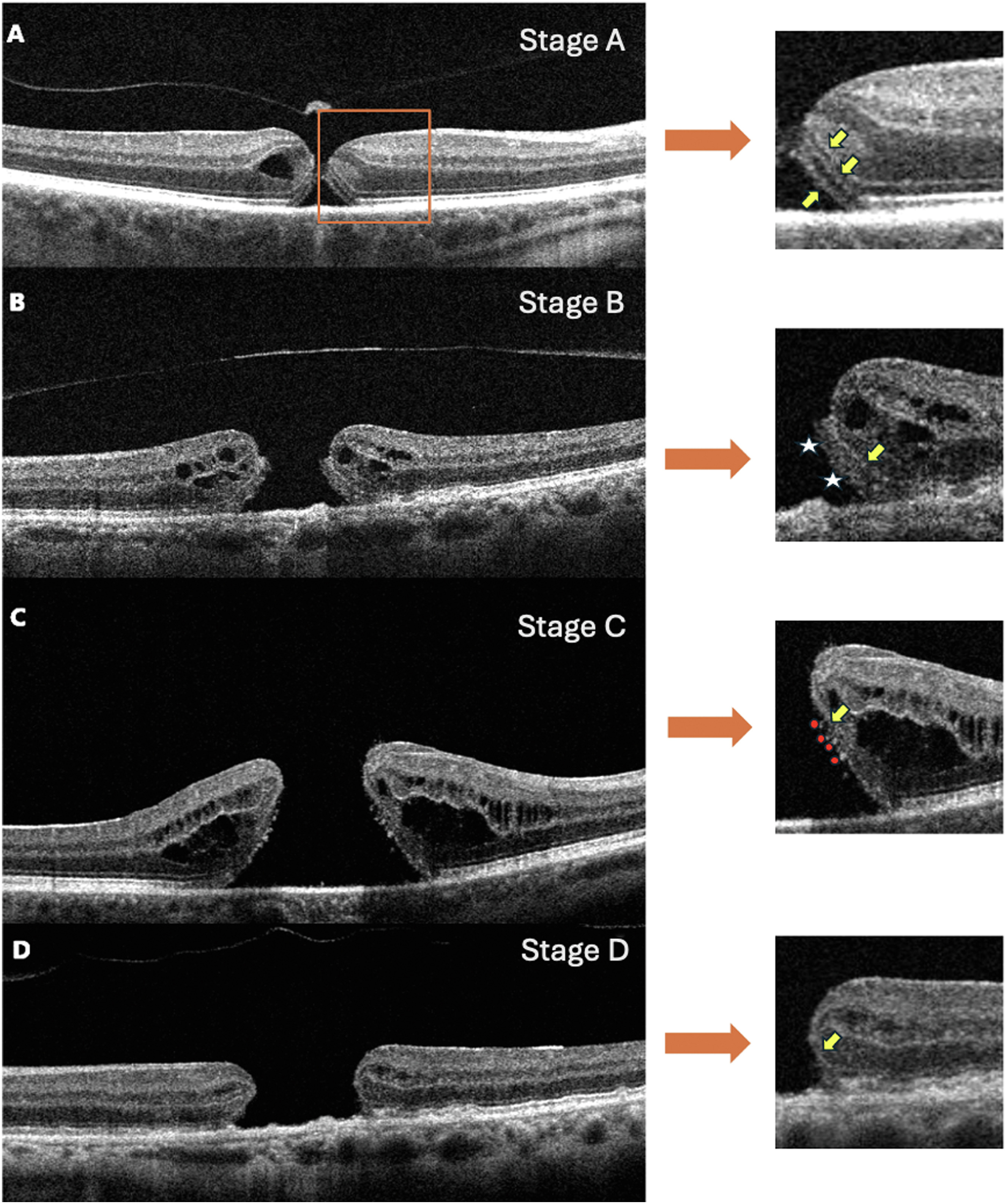 Researchers found that patients presenting with more advanced full-thickness macular hole at baseline had a longer duration of symptoms and worse VA at baseline and three months post-op. This image from the study shows the proposed staging on OCT: Stage A: separation of the neurosensory retina from the RPE, with no apparent changes in the photoreceptor layer (yellow arrows) Stage B: thickening of the photoreceptor layer (asterisks) following Stage A Stage C: patchy loss of photoreceptors, observed as a moth-eaten appearance of the outer retina (red dots), which later progresses to more significant gaps Stage D: outer retinal degeneration where the external limiting membrane is completely exposed (yellow arrow).