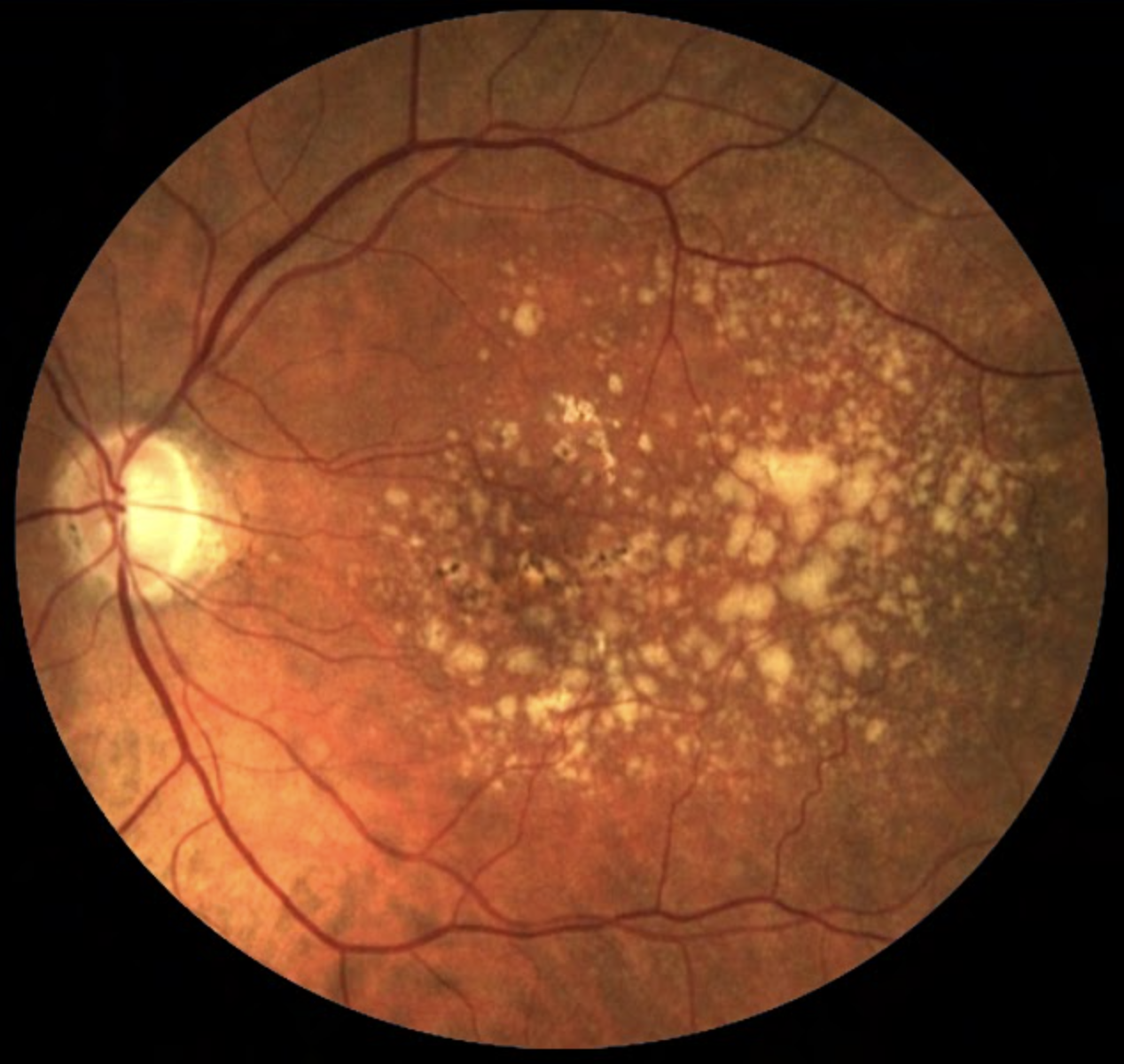 Of the three identified blood metabolites, hypoxanthine may act as a potential free radical generator and serve as an indicator of hypoxic conditions, while 2-furoylglycine is a potential marker of coffee intake, with caffeine metabolism exhibiting potentially perturbed nature in AMD patients. The third agent, 1-hexadecyl-2-azelaoyl-sn-glycero-3-phosphocholine, is less understood in its role with the condition.