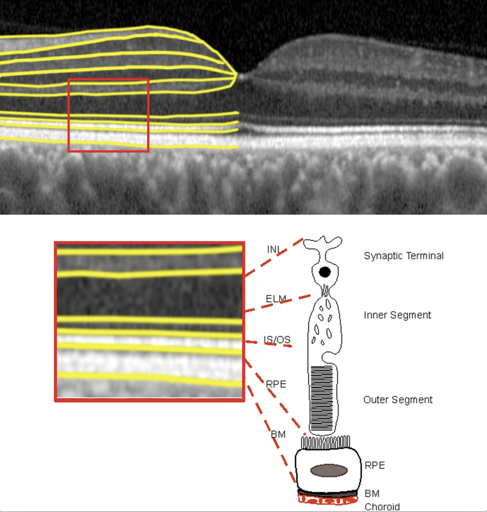 A new study in American Journal of Ophthalmology reveals a surprising and significant link between outer retinal thickness and brain health in patients with normal retinal aging, as well as early and intermediate AMD. Patients found to have thinner outer retina had considerably smaller hippocampus, lower occipital cortex regions of interest thickness, and lower cortical thickness in brain regions involved in Alzheimer’s disease and related dementias. Researchers say retinal imaging could serve a valuable and complementary role in understanding cognitive decline. 