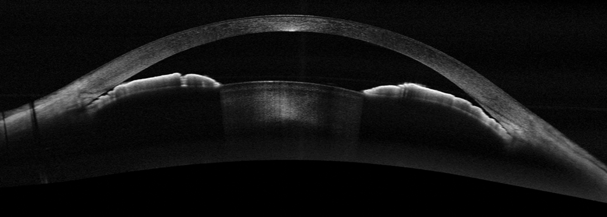 Widefield OCT in a different patient with a narrow angle with iridotrabecular contact. 