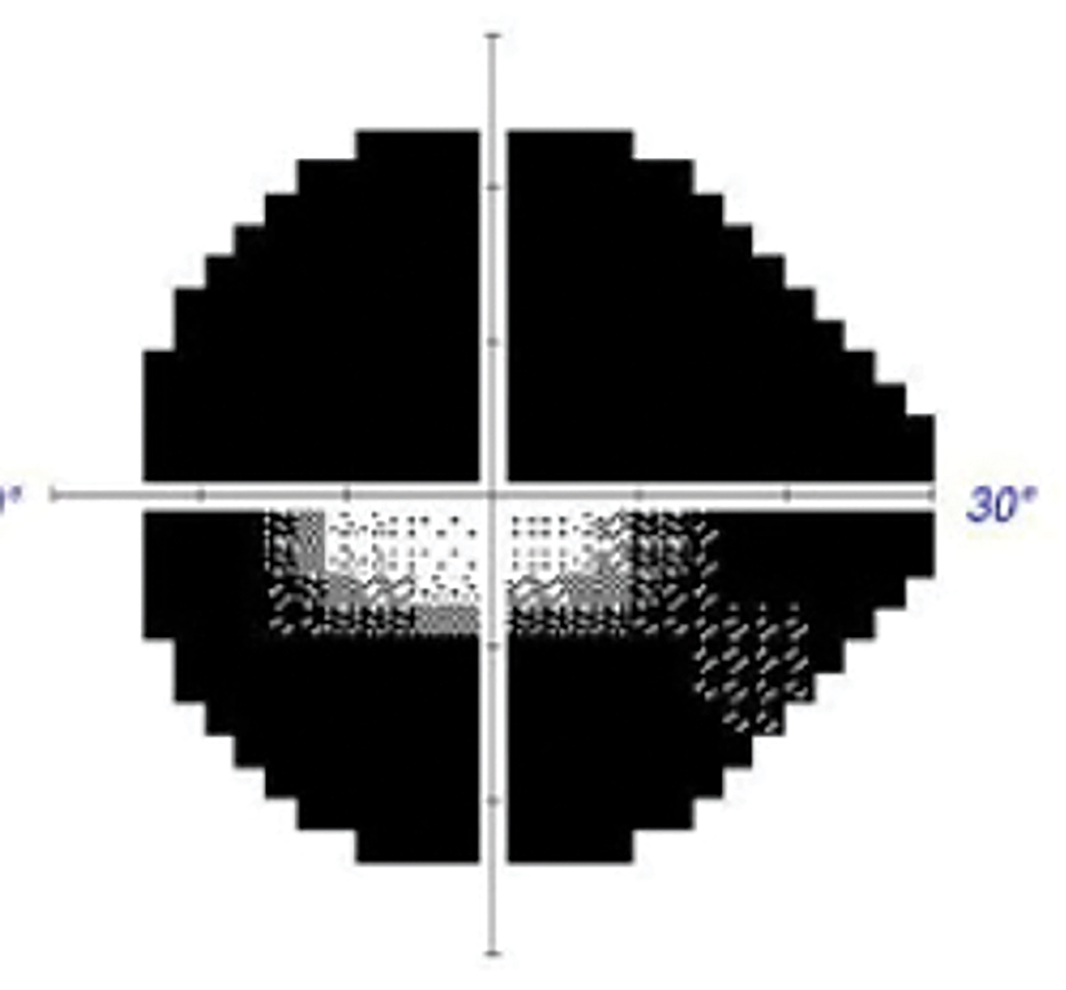 Fig. 4. Accompanying visual field defect in case 3.