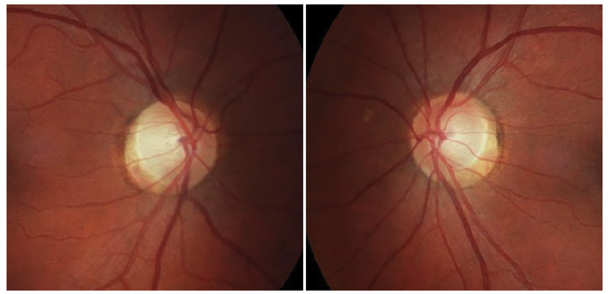 Fig. 5. Optic discs of the patient in case 5.