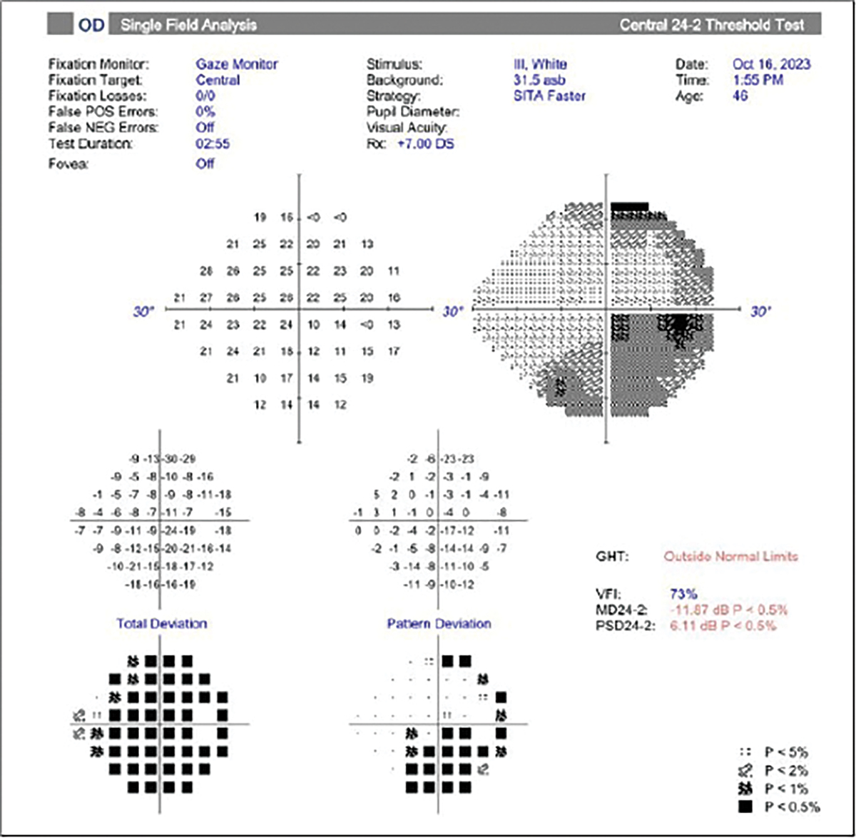 Fig. 6. Visual field of the same patient.