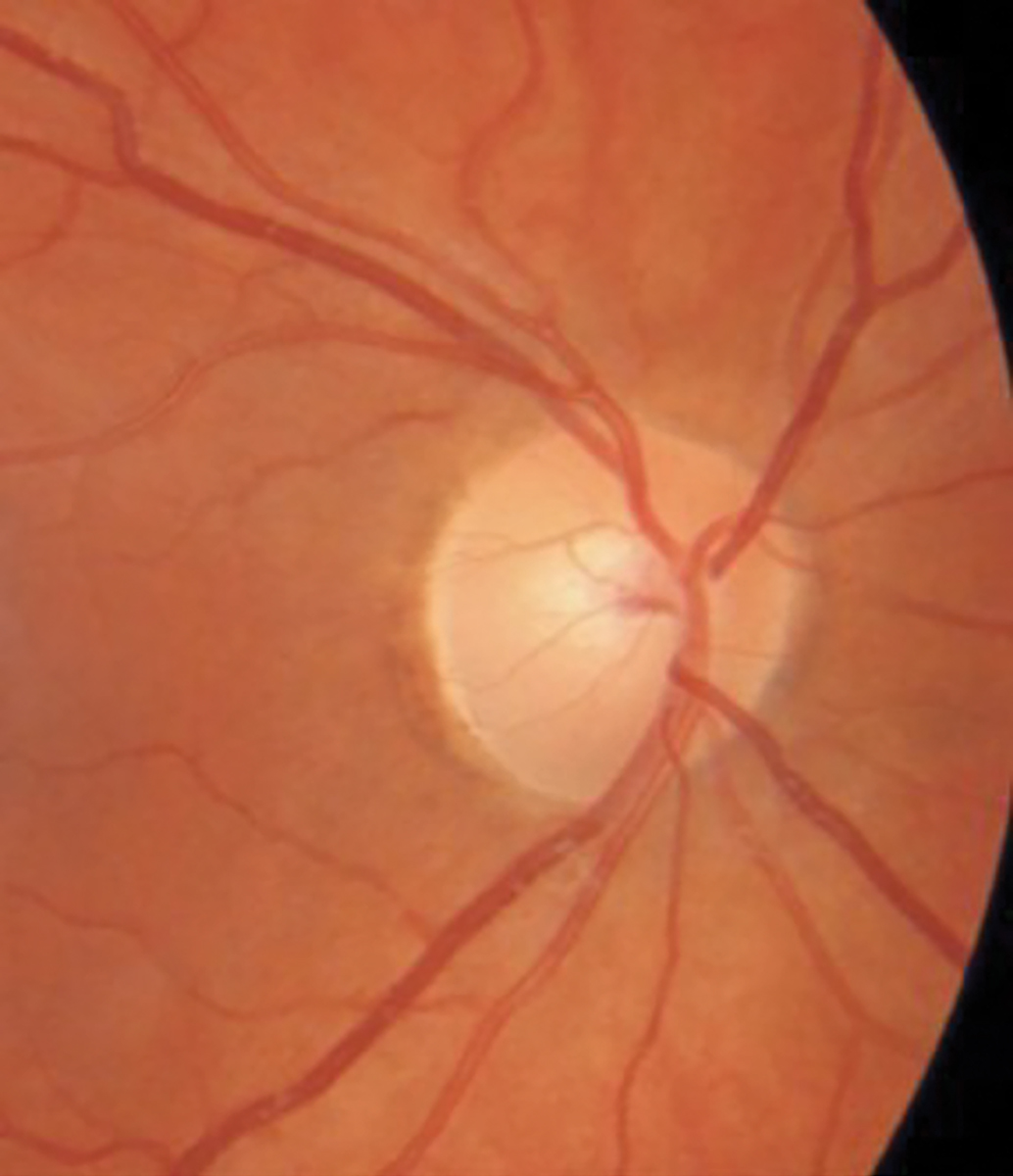 Fig. 7. Normal appearing optic nerve of the case 6 patient.