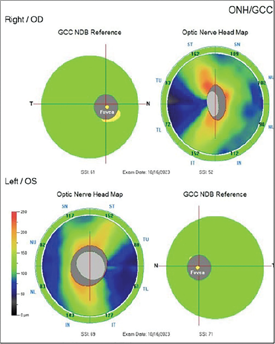 Fig. 8. This same patient’s normal OCT results.