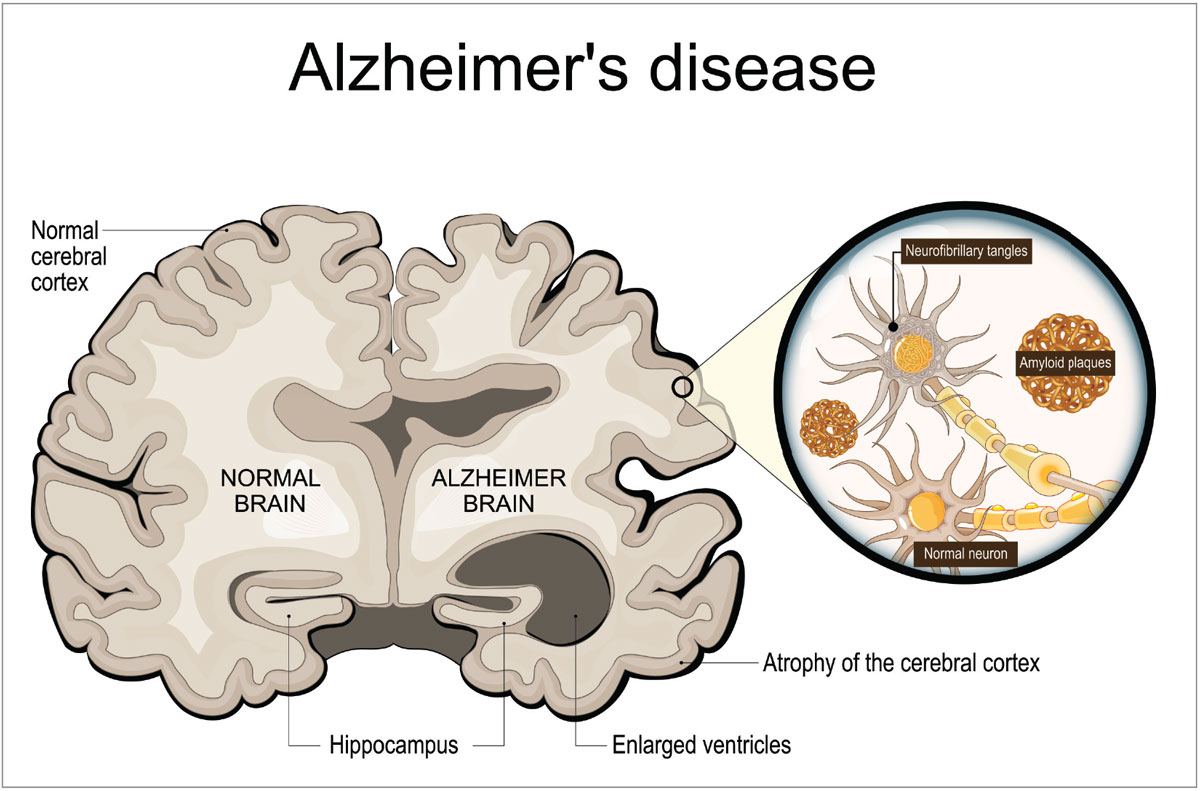 Fig. 1. Neurofibrillary tangles and amyloid plaques accumulate and disrupt neuronal function, resulting in atrophy of the cerebral cortex.