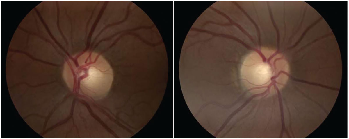 Fig. 2. Optic nerve head images with no abnormalities present.