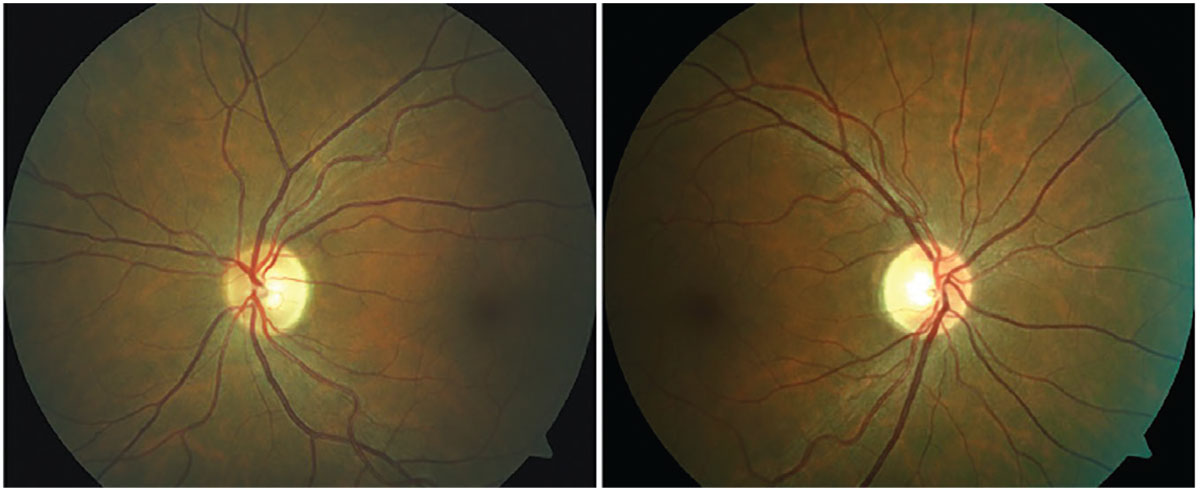 Fig. 4. Asymptomatic bitemporal optic disc pallor representing progressive demyelination of the optic nerve without a history of optic neuritis.