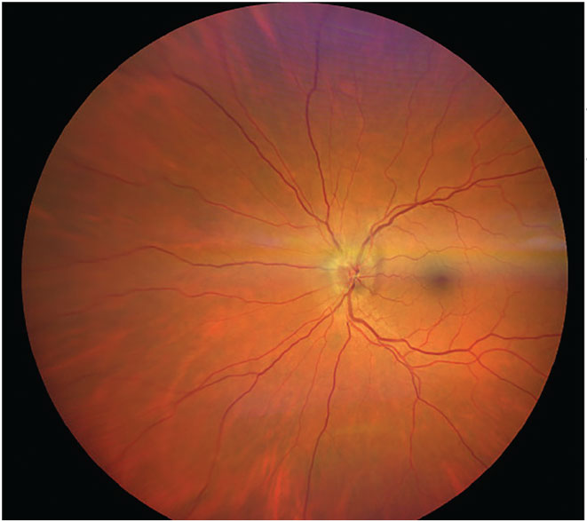 Fig. 7. NAION presented in the left eye.