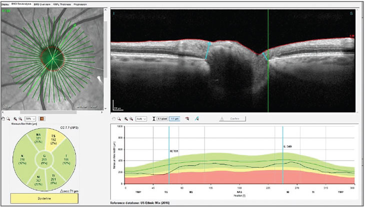 Fig. 2. BMO-MRW measurements of the left neuroretinal rim. Note the slight area of reduced neuroretinal rim thickness in the superior temporal sector of the rim, as highlighted by the green reference line.