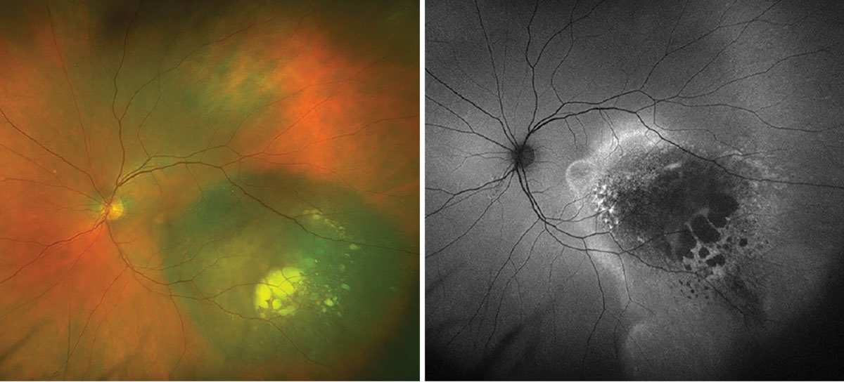 Fig. 1. Optos widefield fundus photography and autofluorescence of the left eye.