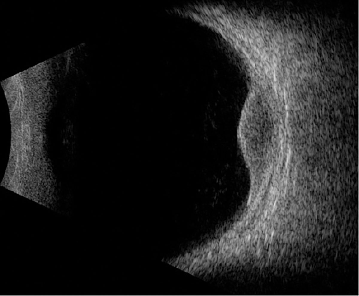 Fig. 3. B-scan ultrasound through the lesion.