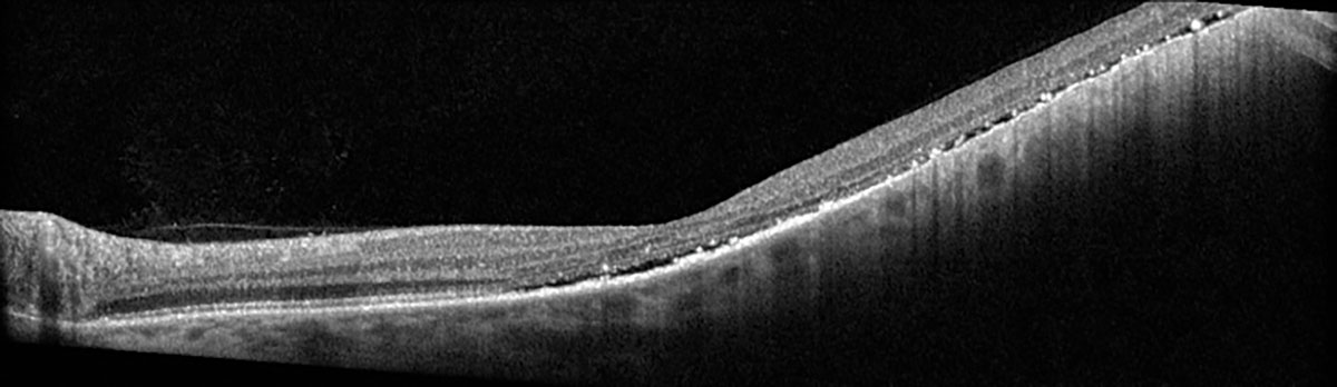 Fig. 5. Heidelberg OCT of the left eye at one-month post-op.