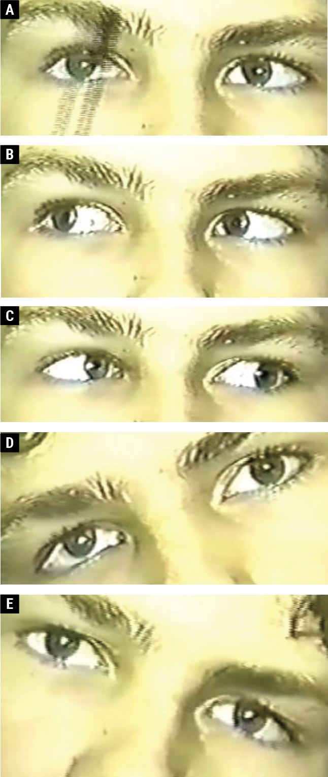 Fig. 2. A 13-year-old male with a right CN IV palsy. The right eye is hyper in primary gaze (A). There is vertical orthophoria in right gaze (B); right hypertropia on left gaze (C); right hypertropia on right head tilt (D); and vertical orthophoria on left head tilt (E).