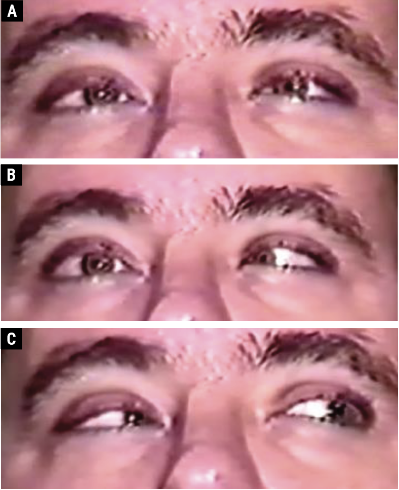 Fig. 3. A 36-year-old male with an ischemic vascular right CN VI palsy. There is orthophoria in primary gaze (A); a right abduction deficit in right gaze (B); and orthophoria in left gaze (C).