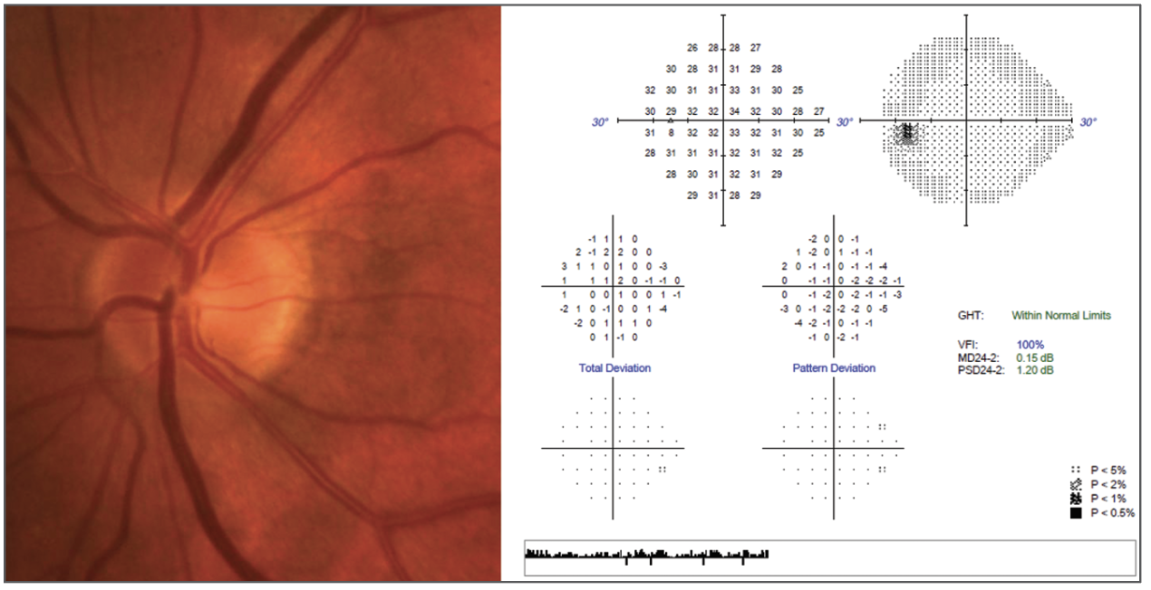 Even after more than 20 years, OHTS still helps stratify risk in patients such as this 68-year-old with average IOPs of 26mm Hg and a 520µm central corneal thickness by ultrasound. Is treatment advisable?