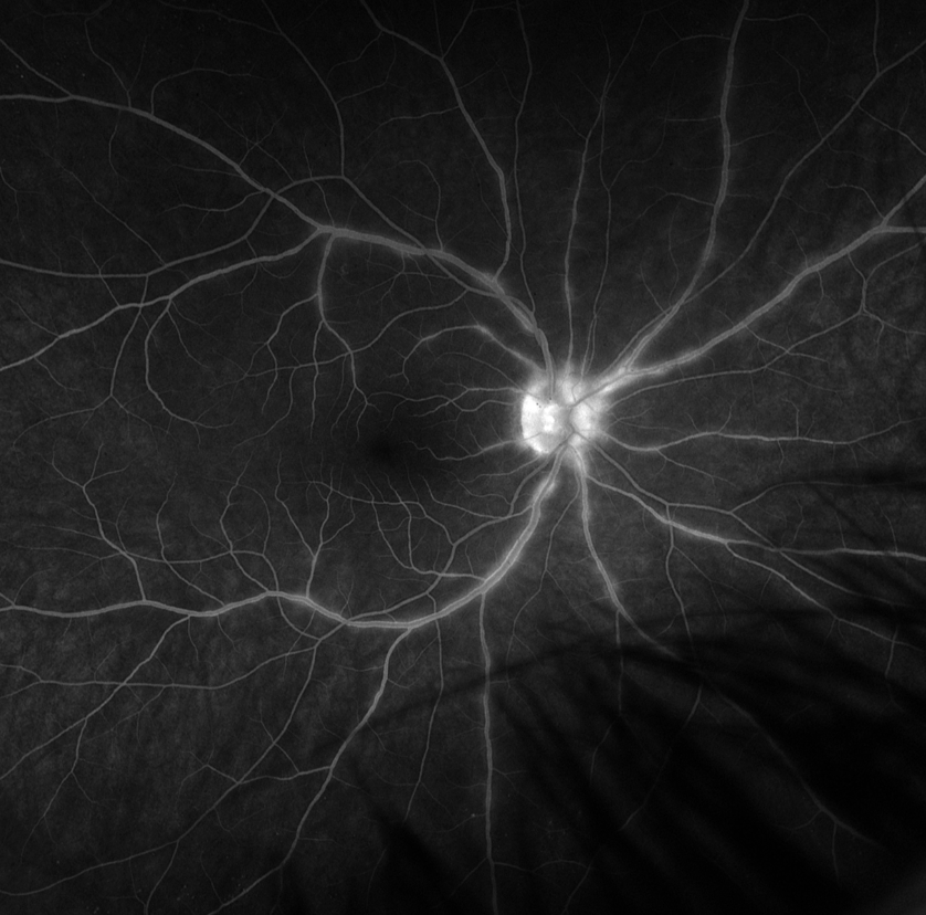 The SUN consensus established definitions and criteria for birdshot chorioretinitis and dozens of other clinical entities.