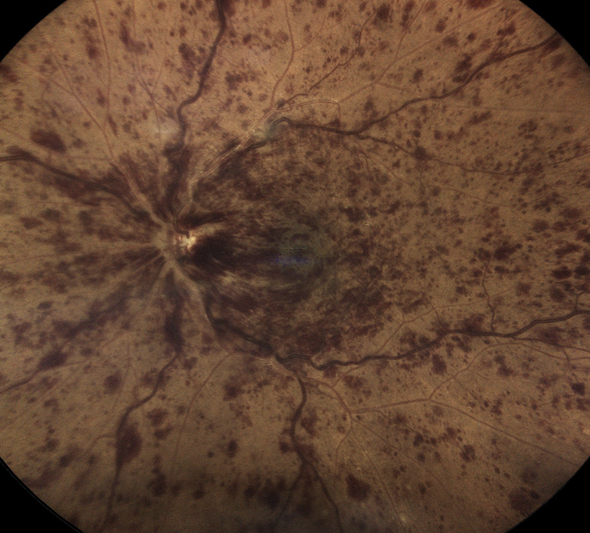 Macular edema due to CRVO was managed with intravitreal steroids in the SCORE and GENEVA trials. 