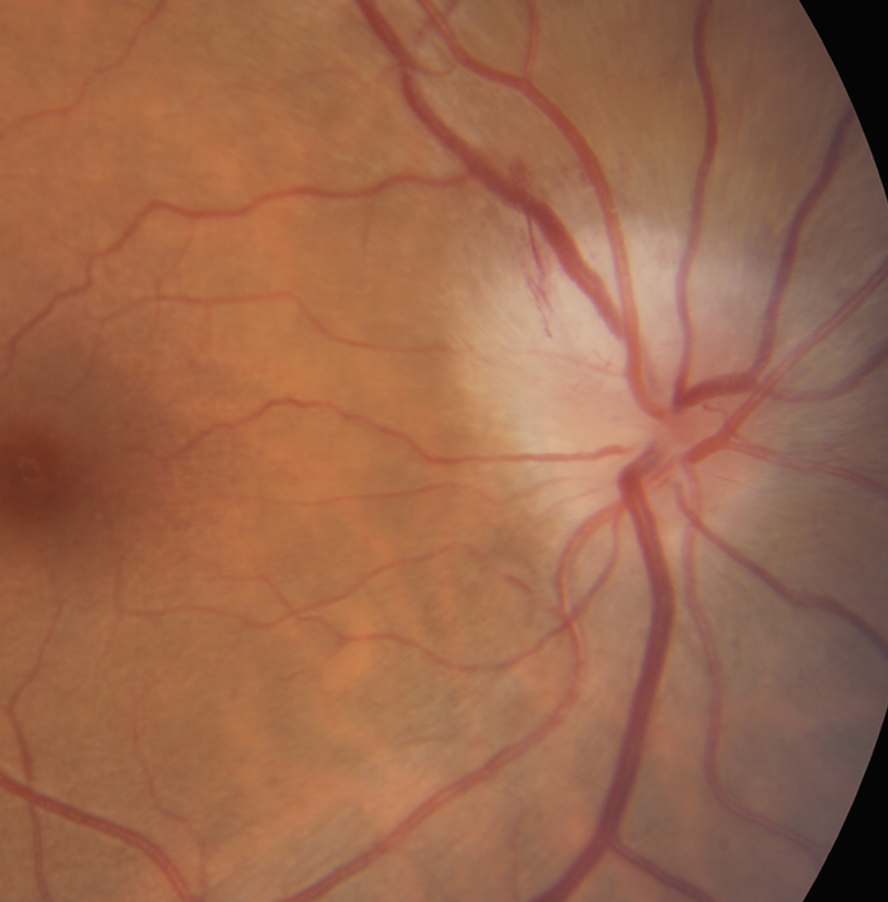 The ONTT explored the safety and efficacy of steroid therapy to treat optic neuritis in patients with multiple sclerosis.